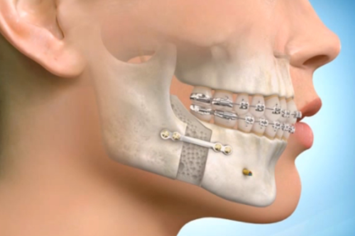 Presurgical-Orthodontics