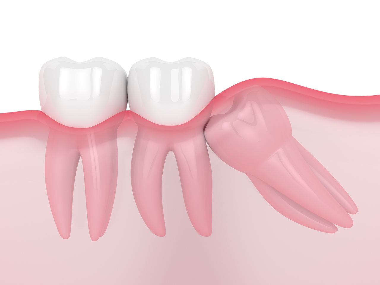 3d render of jaw with wisdom mesial impaction over white background. Concept of different types of wisdom teeth problems.