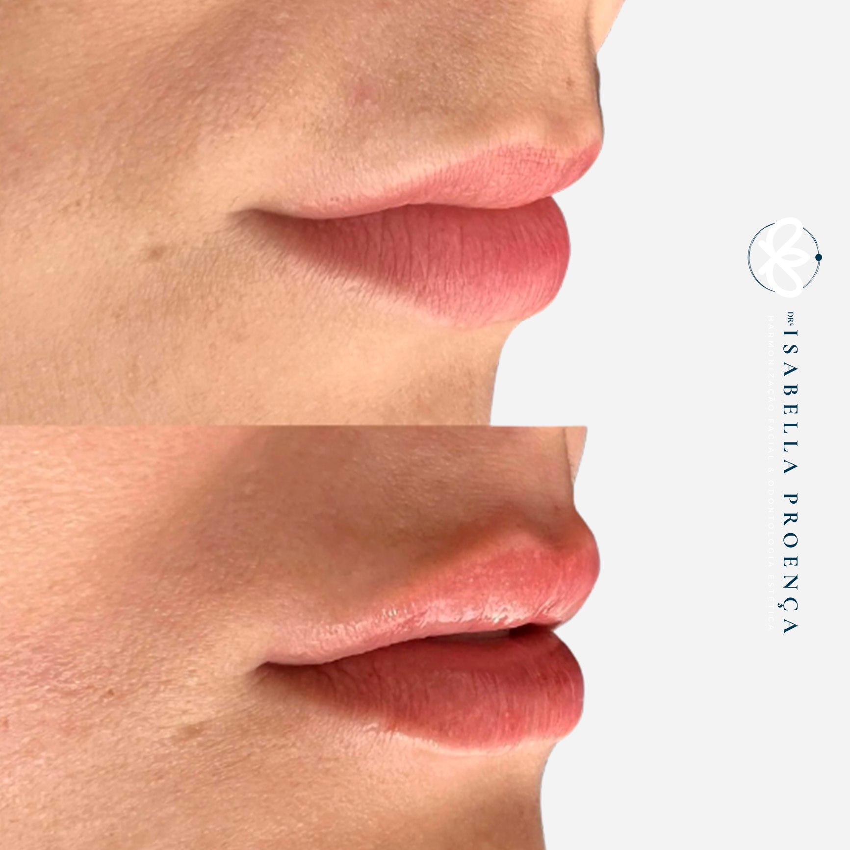 Preenchimento Labial